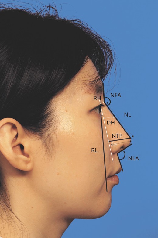To measure dorsal height (DH), a line was drawn from the medial canthus to the alar crease, and a perpendicular line was drawn from this line to reach the rhinion. This second line was the dorsal height. Using again the line drawn from the medial canthus to the alar crease, radix height (RH) was measured perpendicularly from this line to the nasion. Nasal length (NL) was measured from the nasion along the dorsum to the pronasale. Nasal tip projection (NTP) was measured from a line drawn perpendicularly from the white line to the pronasale. A reference length (RL) defined as the distance between the pupil and the lateral commissure was measured. To account for the variability in the objective distance, size and magnification of each photograph, dorsal height, radix height, nasal length, and nasal tip projection were reported as a ratio to this reference line. The nasofrontal (NFA) was the angle between the line used to measure nasal length along the dorsum and a line tangent to the glabella. The nasolabial angle (NLA) was the angle between a line on the anterior surface of the columella and a line on the surface of the upper-lip skin.