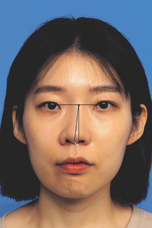 To measure external nasal axis deviation, the nasal axis was measured on frontal photographs. The angle formed between a vertical line starting at the midpoint of the interpupillary line and a line connecting that point with the nasal tip defining point was measured as the degree of external nasal axis deviation.