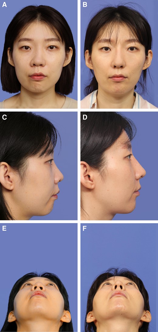 (A, C, E) A 35-year-old female presented with external nasal deviation following a silicone implant. She underwent removal of the silicone implant and revision rhinoplasty. (B, D, F) Postoperative photographs taken at 12 months demonstrated correction of the external nasal deviation in the (B) frontal view, and satisfactory dorsal augmentation and a smooth dorsum in the (D) lateral view. (F) Tip projection was also improved.