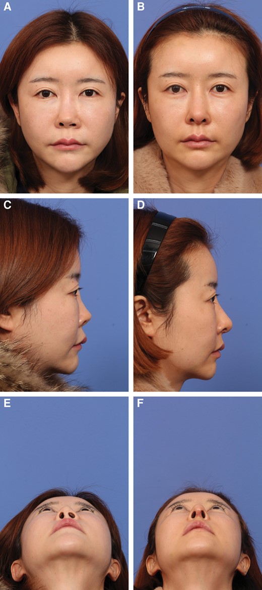 (A, C, E) A 34-year-old female presented with a short and upturned nose following silicone rhinoplasty. She underwent removal of the silicone implant and revision rhinoplasty. (B, D, F) The postoperative photographs were taken at 11 months. (B) In the frontal view, a straight and smooth dorsum is seen following revision surgery with molded glued diced cartilage grafting. Nostril asymmetry has been corrected. (D, F) In the lateral view, lengthening of the nose was achieved, with a more ideal tip position after derotation.