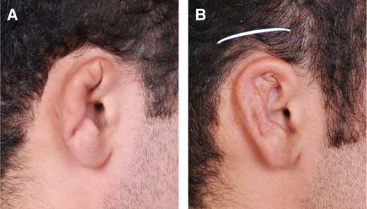 (A) Concha-type ear deformity. (B) Single incision used to insert and adjust framework in place.