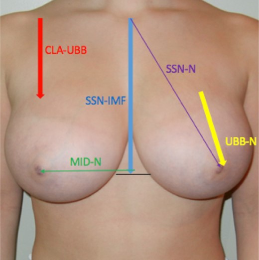 The measurements that were performed both preoperatively and postoperatively by E.H.F. are marked on the photograph of this 17-year-old female breast reduction candidate. Only patients with measurements that were obtained at 1-year follow-up were included in this study. CLA-UBB, clavicle to upper breast border; MID-N, chest midline to nipple; SSN-IMF, suprasternal notch to inframammary fold; SSN-N, suprasternal notch to nipple; UBB-N, upper breast border to nipple. Some of the examples shown in the figures were chosen for illustration purposes and not because they were necessarily all at 1 year follow-up. The changes that they show are consistent with the statistical analysis results.