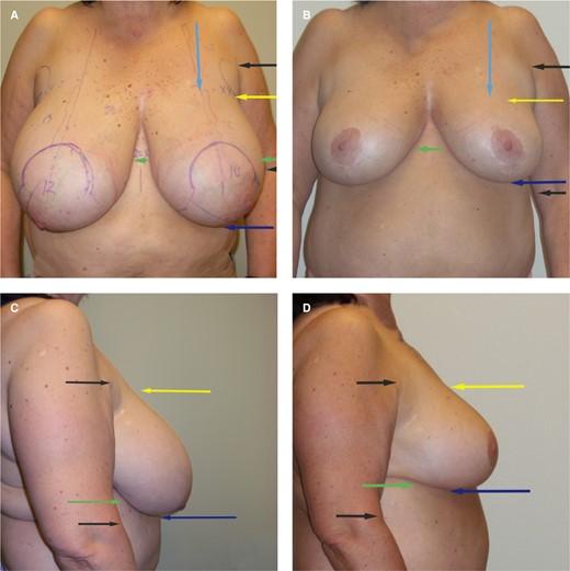 (A, C) Preoperative superomedial vertical breast reduction. (B, D) Postoperative result as seen at 2 years. This 54-year-old female underwent a breast reduction (superomedial pedicle, vertical reduction) with 640 gm removed from the right breast and 610 gm removed from the left breast. She had another 1050 mL of fat removed with liposuction in the lateral chest wall and preaxillary areas, and to shape the inframammary fold. She was 5 feet, 4 inches tall and weighed 174 lb. Note that the upper breast border (yellow arrows) did not change after surgery when compared to the preaxillary crease (upper black arrow). The inframammary fold (green arrow) was elevated when compared to the elbow crease (lower black arrow); our previous paper confirmed a raising of the inframammary fold of on average 1.5 cm. The suprasternal notch to nipple (SSN-N) distance remains where it is marked. The lower border of the breast (dark blue arrow) is where the main effect of the breast reduction is seen. The breast is not pushed up on the chest wall; the lower pole (and lateral) excess is removed.