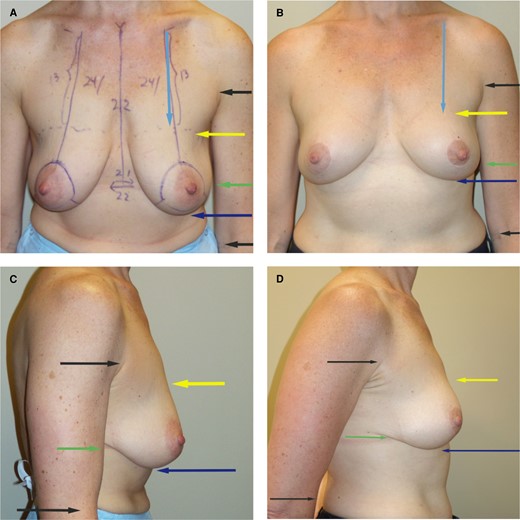 (A, C) Preoperative superior pedicle, inferior flap mastopexy. (B, D) Five-year postoperative result. This 45-year-old female underwent a mastopexy with a superior pedicle and an inferior flap. She was 5 feet, 5 inches tall and weighed 125 lb. Liposuction was not performed. No breast tissue was removed. Note that the upper breast border (yellow arrow) has risen slightly (on average 1 cm). There is more projection from the vertical approach with the inferior flap along with some increase in upper pole fullness. Note that the inframammary fold has not changed much. All of the improvement with a mastopexy is in moving the inferior pole (as opposed to a reduction in which the inferior pole is removed). This is a 5-year follow-up photograph, which shows the long-term stability of this type of mastopexy. The measurements did not change from the 1-year result to the 5-year result.