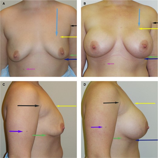 (A, C) Preoperative subglandular breast augmentation. (B, D) Postoperative result. This 27-year-old female underwent a breast augmentation with subglandular smooth-walled silicone gel implants measuring 540 gm each. She was 5 feet, 3 inches tall and weighed 167 lb. Note that the upper breast border (yellow arrow) has been elevated about 2 cm closer to the preaxillary crease (black arrow). The lower breast border (blue arrow) and the IMF (green arrow) have both descended when compared to the purple arrow on the arm and the pink arrow on the abdomen marking a mole for reference. The breast implant is centralized behind the existing nipple position and the upper breast border is elevated, whereas the lower pole (and IMF) descends. IMF, inframammary fold.