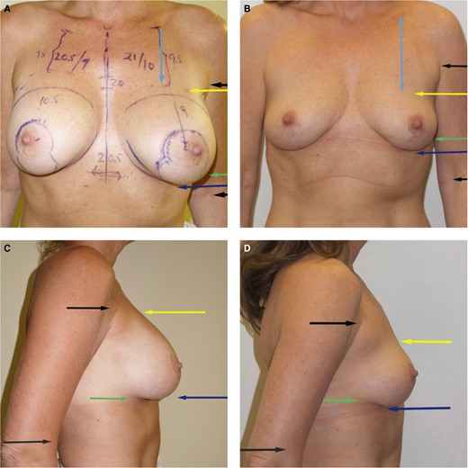 (A, C) Preoperative implant removal and mastopexy. (B, D) Postoperative photographs at 1 year. This 49-year-old female underwent removal of her smooth-walled subpectoral silicone gel implants that were 304 gm each. A mastopexy was performed with no breast tissue removed. She was 5 feet, 4 inches tall and weighed 113 lb. Note that the measurements are reversed when compared to the previous examples. The upper breast border (yellow arrow) has dropped about 2 cm (as compared to the arrow marking the preaxillary crease). The inframammary fold (green arrow) has risen with the weight of the implant removed. Note how little the nipples were elevated. It is essential that the surgeon recognizes that the upper breast border will drop (even more when capsular contracture is present), so it is important not to place the nipples too high.