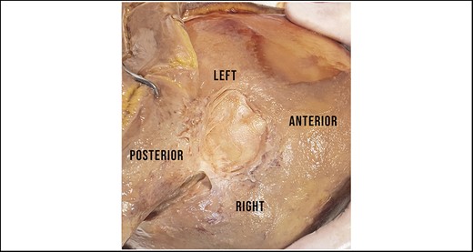 Identification of the strong ligamentous structure, which we suggest naming the “cranial retaining ligament.” Subgaleal dissection within this area always required sharp dissection. The base is circular in shape.
