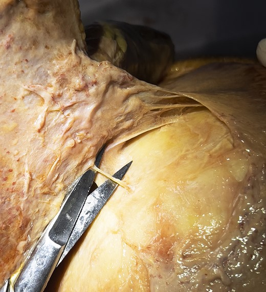 Identification of an emissary vein after full release of the pericranium at the base of the cranial retaining ligament (note the circular dissection through the periost).