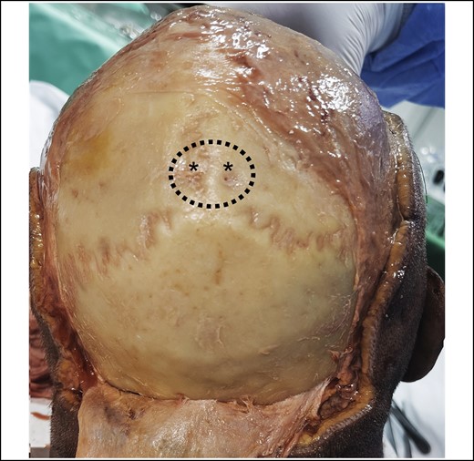 View on the posterior skull after full release of the entire pericranium. The dotted line represents the cylindrical base of the cranial retaining ligament. Note the parietal foramina (marked with asterisks) in the center of the base of the ligament. These are the exit points for the emissary veins, which are running through the cranial retaining ligament.
