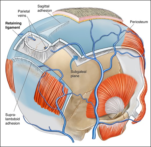 Schematic overview of the shape and localization of the described connective tissue thickenings. The emissary veins exit the parietal foramina in the base of the cranial retaining ligament. The saggital adhesion broadens in width as it is approaching the cranial retaining ligament. The supralambdoid adhesion is running posterocaudal to the retaining ligament. In some specimens a gap could be identified between the ligament and this adhesion; in other specimens there was a bridge of loose areolar tissue. Artwork created by and published with permission from Dr Levent Efe, CMI.