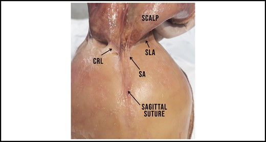 The SA starts in the vertex and runs across the saggital suture towards the CRL. Note how the adhesion gains in width along its superoposterior course. The SLA can be seen bilaterally, posterior to the CRL. CRL, cranial retaining ligament; SA, sagittal adhesion; SLA, supralambdoid adhesion.