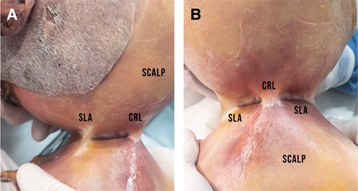 (A) View from the left side of the specimen showing the SLA posterior to the CRL. Just like the CRL, this connective tissue thickening originates from the pericranium and inserts into the galea. The SLA is less dense than the CRL and can be released by blunt dissection, whereas the CRL requires sharp release. (B) Same specimen, anterior view. The CRL is positioned superoanterior to the SLA which runs posterolaterally. CRL, cranial retaining ligament; SLA, supralambdoid adhesion.