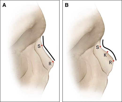 (A, B) V- and S-shaped nasal bones. K, kyphosis; R, rhinion; S, sellion.