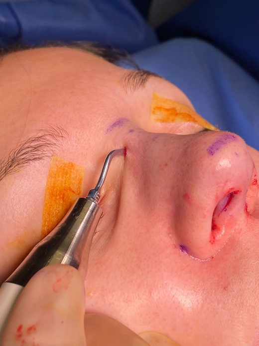 Utilizing the piezoelectric device through the skin of a 35-year-old female patient.