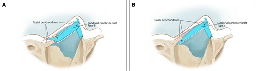 (A, B) Subdorsal cantilever graft types A and B.