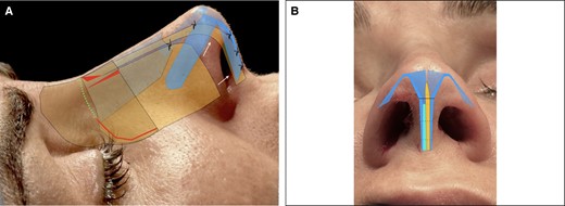 (A, B) Septal advancement flap applied to the spare roof technique in a 44-year-old female patient.