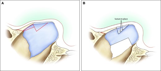 (A, B) Subdorsal Z-flap.