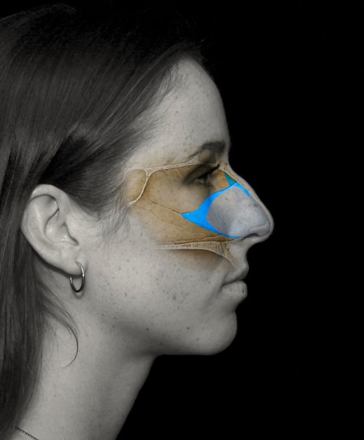Low septal strips shown in a 23-year-old female patient.
