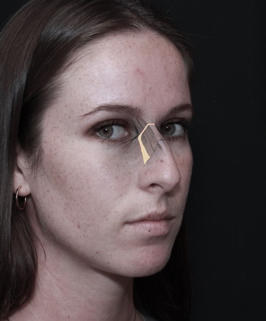 Let-down shown in a 23-year-old female patient.