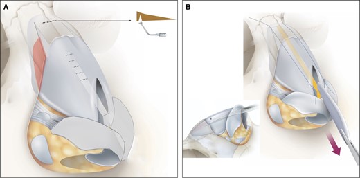 Spare roof technique B. (A) Lateral wall and subdorsal ostectomy. (B) High strip and central compartment.