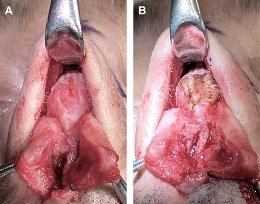 Chondroplasty with electrocautery (Colorado needle) of the upper lateral cartilage shoulders in a 38-year-old male patient.