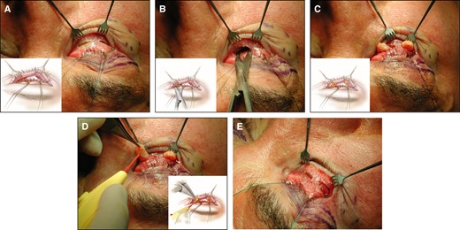 Surgical techniques of transconjunctival approach, dissection, fat exposure, and excision in a 71-year-old male patient. (A) Subtarsal incision and proper exposure (with a sulcus suture and retractor). (B) Access to fat compartment. (C) Orbital fat exposure. (D) Fat resection. (E) Procedure ending with uncovered wound.
