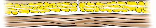 Skin flap margins in apposition after measured resection prior to final layered wound closure for patients with mean gray value <0.127.