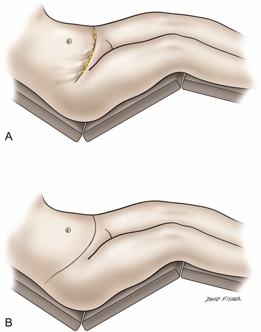 Avoidance of pleating: (A) pleating along lateral abdominoplasty incision and (B) incision extended laterally to make up skin length mismatch and avoid pleating.