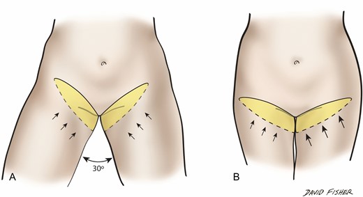 Thigh lift skin excision is planned and measured (A) with thighs at 30° of abduction rather than (B) with the thighs fully adducted.