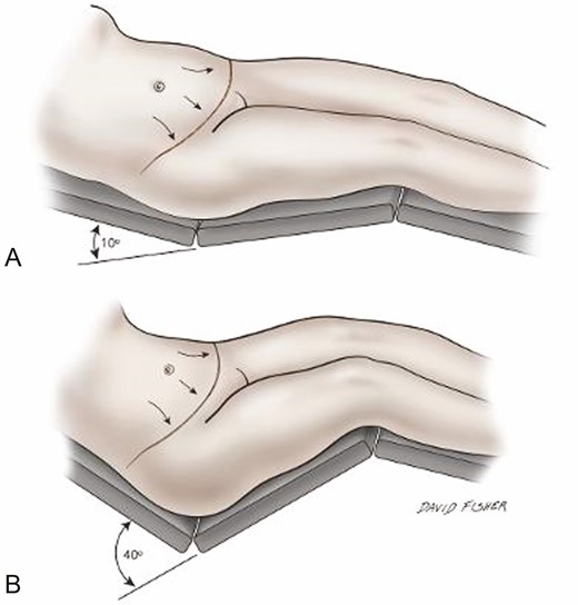 Abdominoplasty skin excision is planned and measured (A) with waist flexed at 10° or less rather than (B) with typical waist flexion.