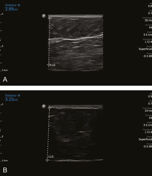 Variation of the SFS in the presence of obesity. (A) Ultrasound image of the subcutaneous tissue in the lower quadrant of the abdomen of a patient with a BMI of 33 kg/m2 undergoing abdominoplasty. A substantial, horizontally oriented, dominant band of SFS is identified in the subcutaneous tissue. The vertically oriented white dashed line marks the subcutaneous layer, measuring 2.89 cm. The corresponding mean gray value is 0.1800279, which indicates strong tissue quality and exceeds the threshold value of 0.127 in this study. (B) Ultrasound image of the subcutaneous tissue in the lower quadrant in a similar patient with a BMI of 33 kg/m2 also undergoing abdominoplasty. The SFS is not identified. The vertically oriented dashed line on the left marks the subcutaneous layer, measuring 3.23 cm. The corresponding mean gray value is 0.025769, indicating poor tissue quality. SFS, superficial fascial system.