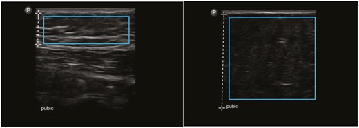 Ultrasound images marked by the vertical dashed lines indicating the differing depths of subcutaneous suprapubic fat in two patients undergoing abdominoplasty. The blue rectangles demonstrate the areas of subcutaneous tissue cropped by XnView and then analyzed by CellProfiler. Left: multiple horizontally-oriented streaks of white, reflective collagen indicate strong SFS in this area with a corresponding MGV of 0.16296. Right: subcutaneous tissue almost devoid of collagen indicates weak SFS with a corresponding MGV of 0.06206.