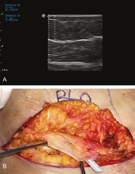 (A) Ultrasound image of the subcutaneous tissue in the right lower quadrant of the abdomen of a 66-year-old female patient with a BMI of 27 kg/m2 undergoing abdominoplasty. The thickness of the subcutaneous tissue is 2.72 cm (vertical dashed line, +---+), and the depth of the dominant band of SFS is 1.42 cm (vertical dashed line, ×---×). The mean gray value is 0.185487, which indicates a robust SFS. (B) Corresponding intraoperative photograph of the same area in the same patient undergoing abdominoplasty. The substantial layer of SFS (Scarpa’s fascia) has been dissected and is being held by the two Allis tissue forceps. SFS, superficial fascial system