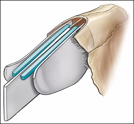 The isolated utilization of a spreader graft can be insufficient to push the upper lateral cartilages against the nasal bones. Even a graft of sufficient width to push the upper lateral cartilages against the nasal bones will not support the side walls, allowing collapse and a step-off across the lateral keystone.