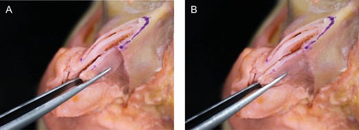 Anatomic dissection demonstrating the nose after dorsal hump resection, (A) before and (B) after caudal traction on the upper lateral cartilage. Note how this maneuver pulls the upper lateral cartilages back toward the nasal bone.