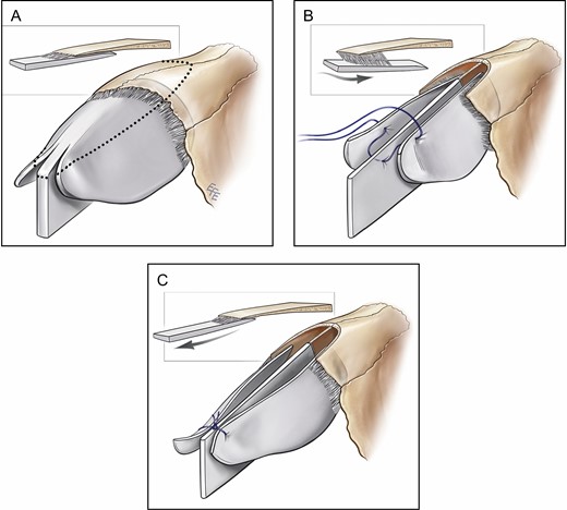 Illustration of the pathophysiology and the prevention of inverted-V deformity. (A) In an intact dorsum, the upper lateral cartilages are pushed anteriorly, laterally, and caudally against the nasal bones. (B) Dorsal hump resection causes the upper lateral cartilages to migrate posteriorly, medially, and cephalad, creating a step-off. (C) Caudal traction restores the anatomic relationship between the upper lateral cartilages and the nasal bones. Note that the suture is placed proximal to where the upper lateral cartilages diverge.