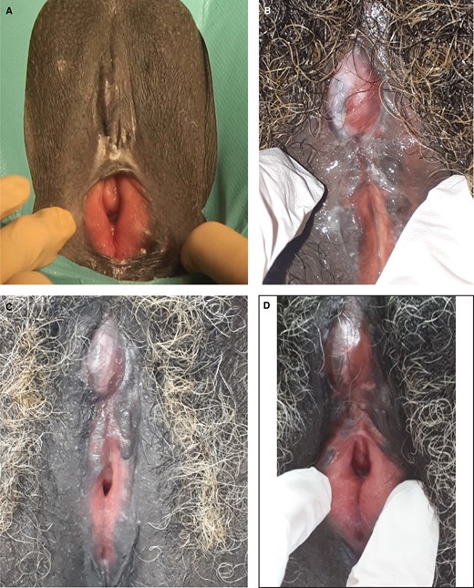 This 51-year-old female presented with type IIIa female genital mutilation/cutting. (A) Before surgery. (B) Postoperative check at day 67: starting of re-epithelialization, there was no need of pain killers. (C) Postoperative check at 3 months: re-epithelialization completed; masturbation resumed. (D) Postoperative check at 6 months.