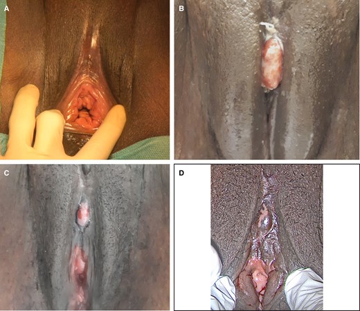This 35-year-old female presented with type IIb female genital mutilation/cutting. (A) Before surgery. (B) Postoperative check at day 22: not yet re-epithelialized, the pain was successfully managed with pain killers. (C) Postoperative check at day 46: an advanced state of re-epithelialization, no pain killer intake. (D) Postoperative check at day 70: re-epithelialization almost completed, no pain (menstruation).37