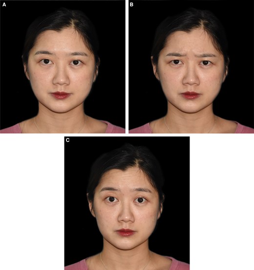 Photographs of a normal 27-year-old female. (A) No expression; (B) frown movement; and (C) eyebrow lifting.
