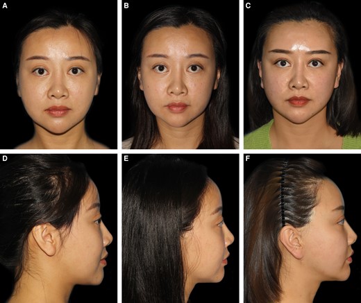 Photographs of botulinum toxin-A injection results of a 39-year-old female with a flat forehead (A, D) who showed unsatisfying postoperative improvements (B, E) without botulinum toxin-A (BTX-A) injection. After another frontotemporal filling with BTX-A injection (C, F), significant improvement was observed.