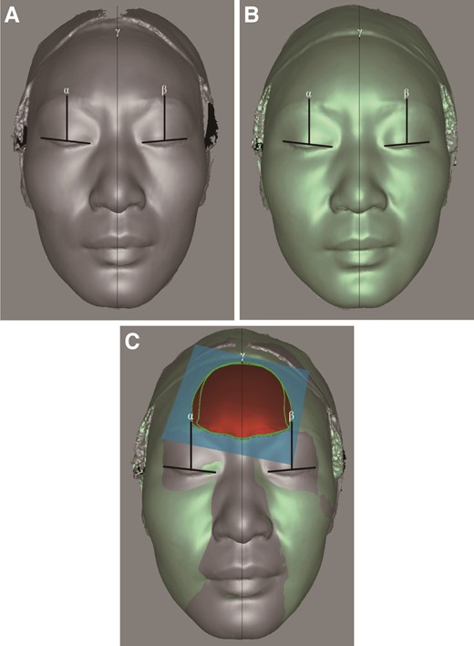 Schematic images of volumetric measurements obtained with Artec Studio 13 professional software (A) Before treatment; (B) 6 months after treatment; and (C) overlapping images of before and after treatment.