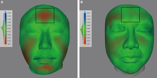 Schematic diagram of facial volume cloud images composited of 3-dimensional scans before and 6 months after treatment (A) Fusion image of patient with botulinum toxin-A (BTX-A) injected; and (B) fusion image of patient without BTX-A injected.
