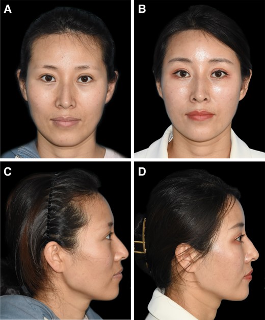 Photographs of botulinum toxin-A injection results of a 34-year-old female with a flat forehead (A, C) who showed satisfying postoperative improvements (B, D) with botulinum toxin-A (BTX-A) injection.
