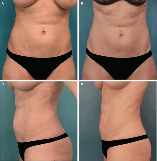 Images of this 47-year-old female patient who received 1 treatment with 36 mL of ATX-101 in the lower abdomen. (A, C) Front and lateral views of the abdomen prior to ATX-101 injections and (B, D) front and lateral views of the abdomen 3 months after treatment.