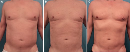 Images of this 52-year-old male patient who received 1 treatment with ATX-101 in the lower and upper abdomen (47 cc to the right and 47 cc to the left). (A) Abdomen prior to ATX-101 injections, (B) abdomen 3 months after treatment, and (C) abdomen 5 months after treatment.
