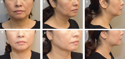 Images of this 44-year-old female patient who received 3 treatments with ATX-101 in the jowl. (A, C, E) Front, oblique, and lateral views of the jowl prior to ATX-101 injections, and (B, D, F) front, oblique, and lateral views of the jowl 3 months after her third treatment.
