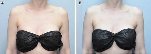 Images of this 38-year-old female who received ATX-101 to her right and left anterior periaxillary fat. (A) Anterior periaxillary fat before her first treatment and (B) anterior periaxillary fat 1 day after her first treatment showing signs of edema, erythema, and bruising.