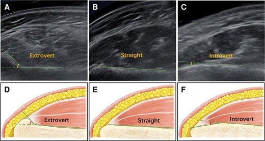 Ultrasound and schematic diagram of the mandibular angle classifications: (A, D) extrovert: more than 5° of mandibular angle extroversion; (B, E) straight: less than 5° of introversion or extroversion; and (C, F) introvert: more than 5° of mandibular angle introversion.