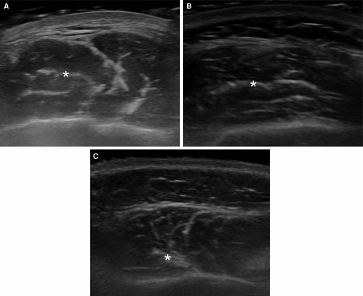 Ultrasound images of the DIT classifications. DIT marked by an asterisk (*) symbol. (A) compartmentalized DIT, (B) transverse DIT, and (C) longitudinal DIT. DIT, deep inferior tendon.