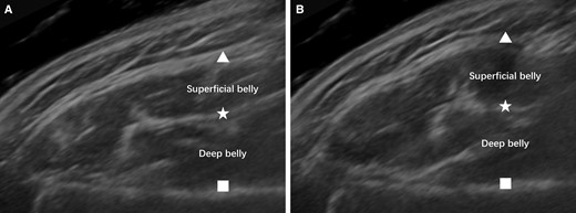Ultrasound image of the masseter in static (A) and clenching (B) states. Significant bulging of the masseter can be observed from the ultrasound image. Triangle, masseter fascia; star, deep inferior tendon; square, mandible surface.